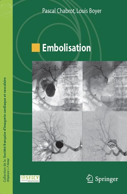 Embolisation - 