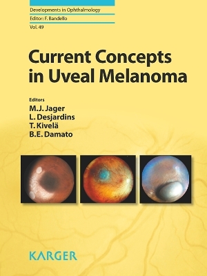 Current Concepts in Uveal Melanoma - 