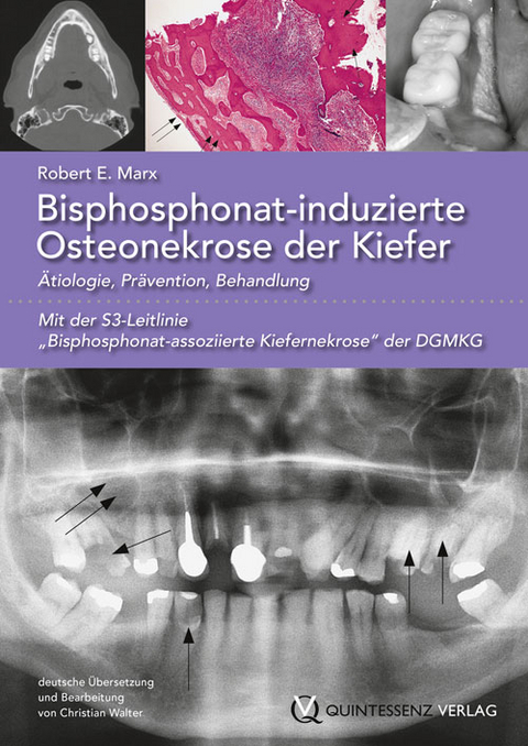 Bisphosphonat-induzierte Osteonekrose der Kiefer - Robert E. Marx