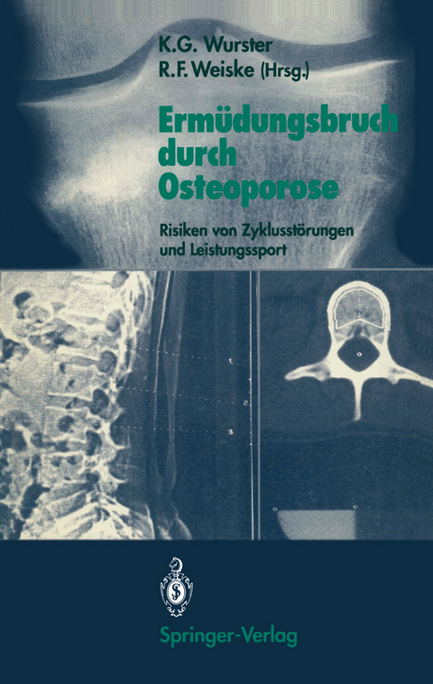 Ermüdungsbruch durch Osteoporose - 