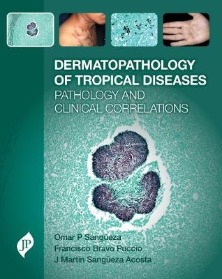 Dermatopathology of Tropical Diseases - Omar P Sangüeza, Martin Sangüeza, Francisco Bravo