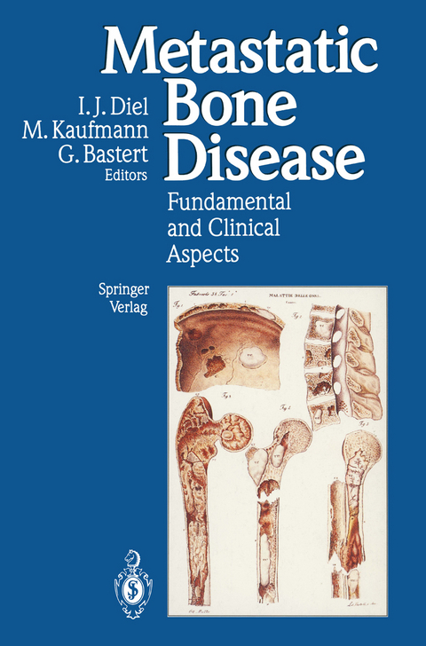 Metastatic Bone Disease - 