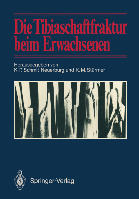 Die Tibiaschaftfraktur beim Erwachsenen - 