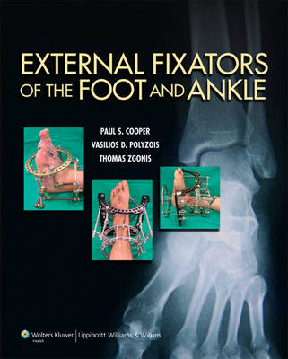 External Fixators of the Foot and Ankle - 