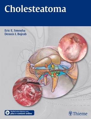 Cholesteatoma - Eric E. Smouha, Dennis I. Bojrab