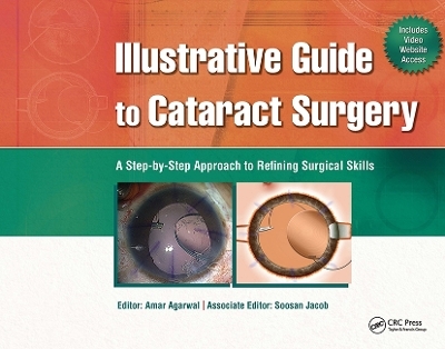 Illustrative Guide to Cataract Surgery - Amar Agarwal