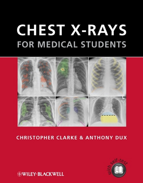 Chest X–rays for Medical Students - Christopher Clarke, Anthony Dux