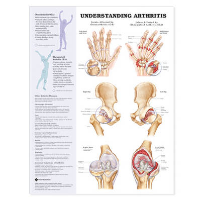 Arthritis - Joint Inflammation -  Anatomical Chart Company