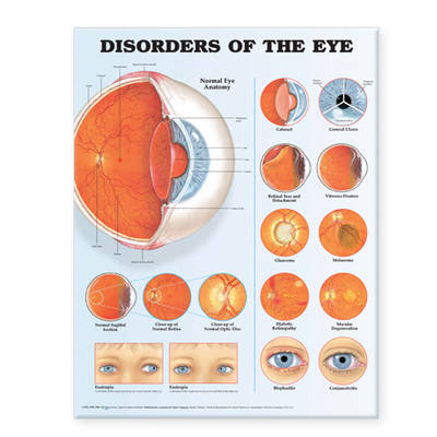 Disorders of the Eye Anatomical Chart