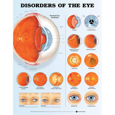 Disorders of the Eye Anatomical Chart