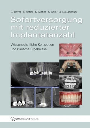 Sofortversorgung mit reduzierter Implantatanzahl - Frank Kistler, Georg Bayer, Steffen Kistler, Stephan Adler, Jörg Neugebauer, Fabian Sigmund, Freimut Vizethum, Michael Weiss