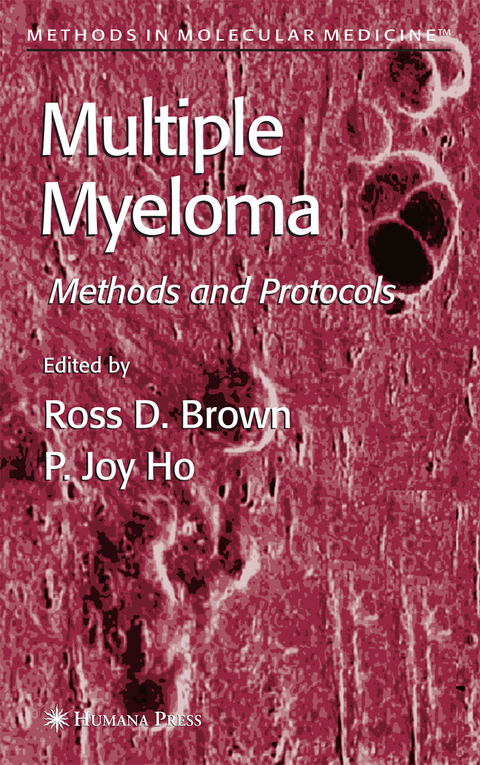 Multiple Myeloma - 