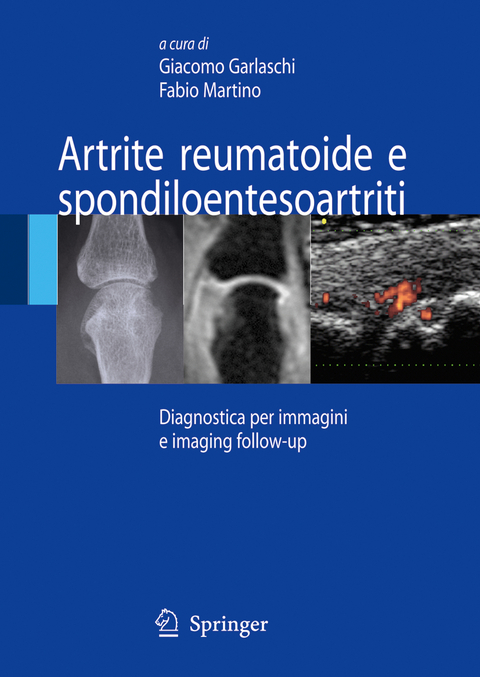 Artrite reumatoide e spondiloentesoartriti - 