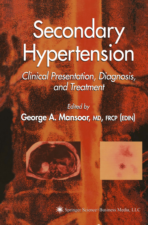 Secondary Hypertension - 