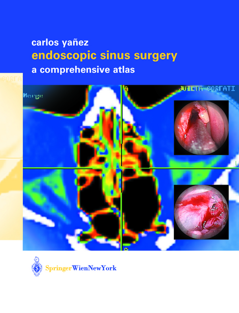 Endoscopic Sinus Surgery - Carlos Yañez