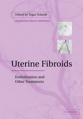 Uterine Fibroids - 