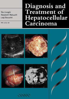 Diagnosis and Treatment of Hepatocellular Carcinoma - 