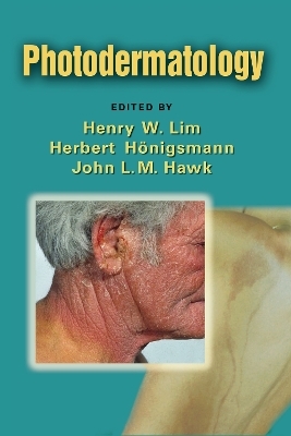 Photodermatology - 