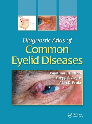 Diagnostic Atlas of Common Eyelid Diseases - Jonathan J. Dutton, Gregg S. Gayre, Alan D. Proia