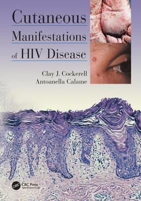 Cutaneous Manifestations of HIV Disease - Clay Cockerell, Antoanella Calame