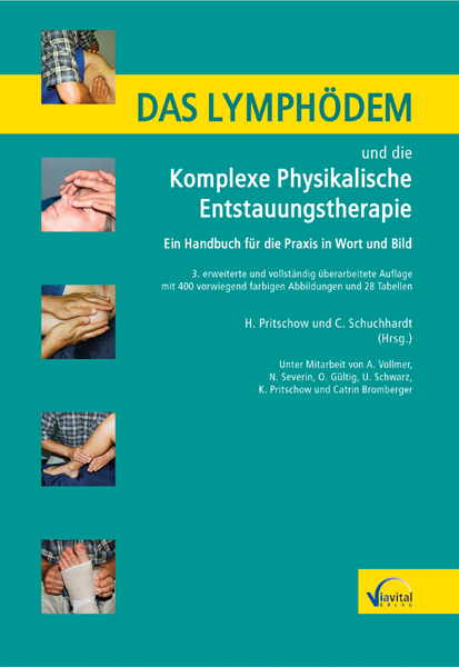 Das Lymphödem und die Komplexe Physikalische Entstauungstherapie - 