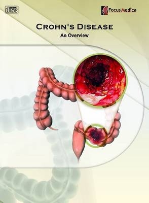 Crohn's Disease - 