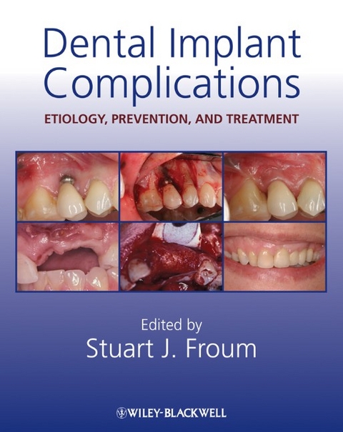 Dental Implant Complications - 