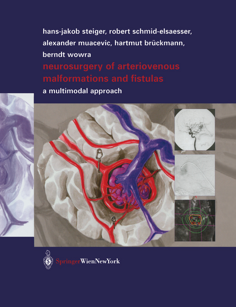 Neurosurgery of Arteriovenous Malformations and Fistulas - Robert Schmid-Elsaesser, Alexander Muacevic, Hartmut Brückmann, Berndt Wowra