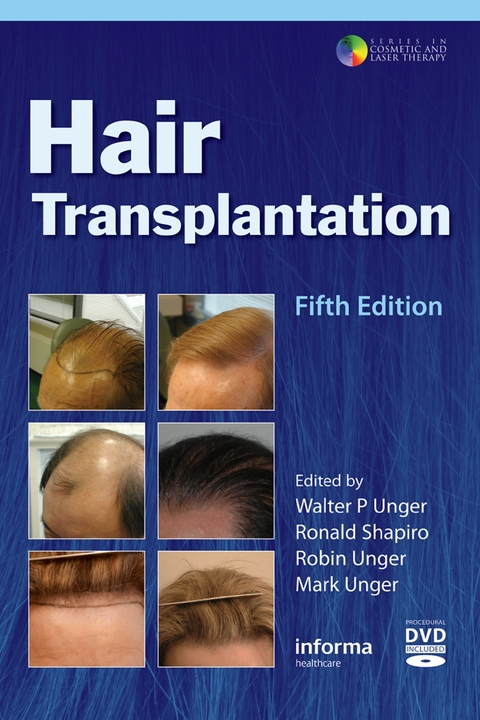 Hair Transplantation - 