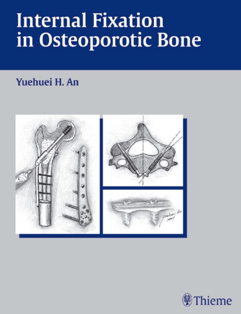 Internal Fixation in Osteoporotic Bone / Edited by Yuehuei H. an. - Yuehuei H. An