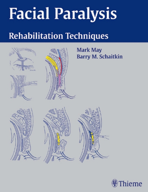 Facial Paralysis - 