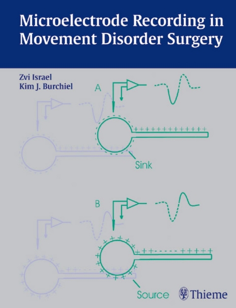 Microelectrode Recording in Movement Disorder Surgery - 