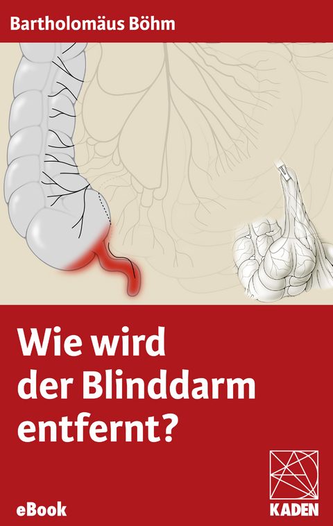 Wie wird der Blinddarm entfernt? -  Bartholomäus Böhm