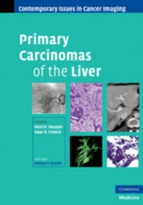 Primary Carcinomas of the Liver - 