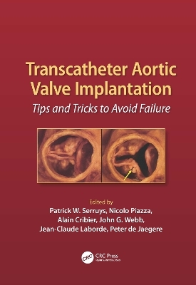 Transcatheter Aortic Valve Implantation - 