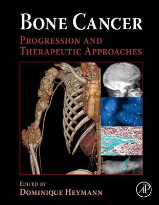 Bone Cancer - 