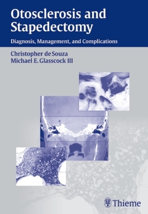 Otosclerosis and Stapedectomy - Michael E. Glasscock Christopher de Souza