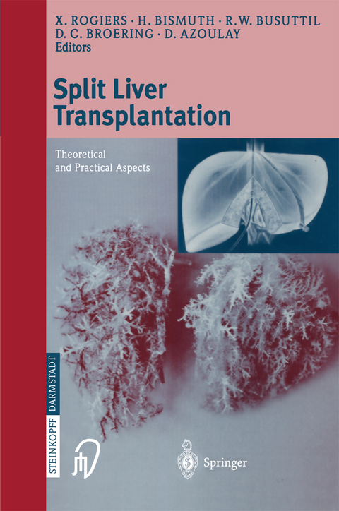 Split liver transplantation - 