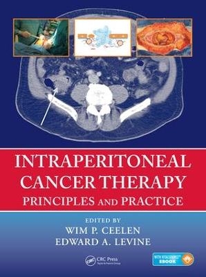 Intraperitoneal Cancer Therapy - 