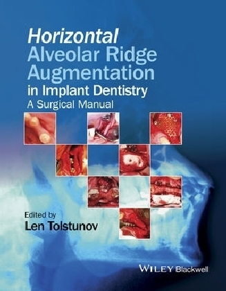 Horizontal Alveolar Ridge Augmentation in Implant Dentistry - Len Tolstunov