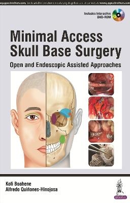 Minimal Access Skull Base Surgery - 