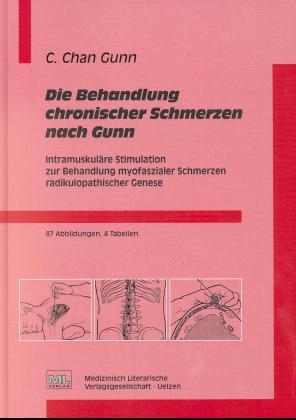 Die Behandlung chronischer Schmerzen nach Gunn - C Chan Gunn