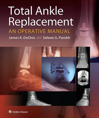 Total Ankle Replacement