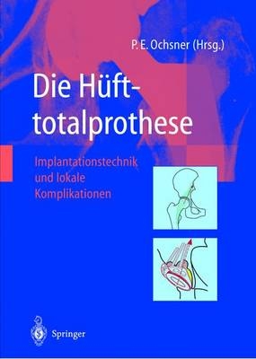 Die Hüfttotalprothese - 