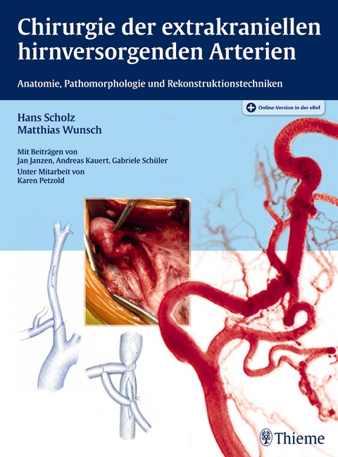 Chirurgie der extrakraniellen hirnversorgenden Arterien - Hans Scholz, Matthias Wunsch