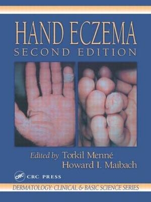 Hand Eczema - 