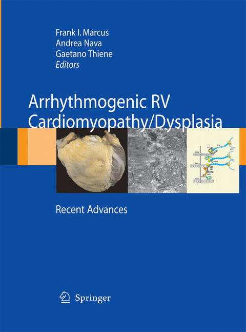 Arrhythmogenic RV Cardiomyopathy/Dysplasia - 