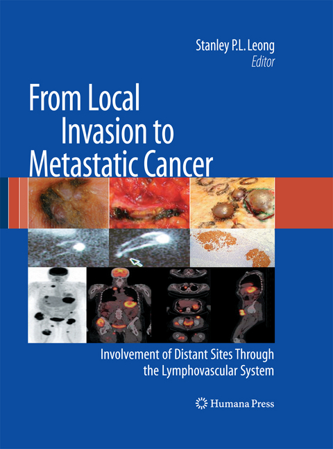 From Local Invasion to Metastatic Cancer - 