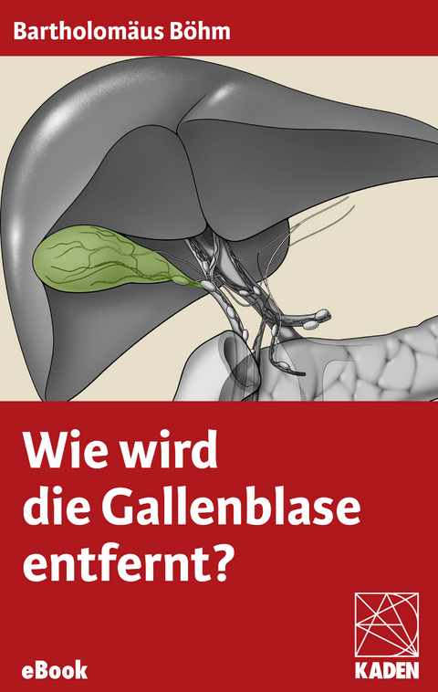 Wie wird die Gallenblase entfernt? -  Bartholomäus Böhm