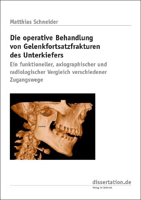 Die operative Behandlung von Gelenkfortsatzfrakturen des Unterkiefers - Matthias Schneider